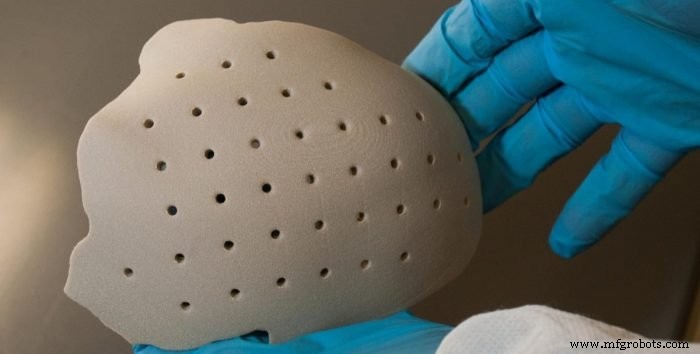 Knochenimplantate revolutioniert: Wie 3D-Druck Passform, Langlebigkeit und Performance verbessert