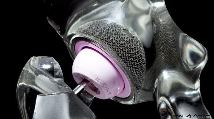Knochenimplantate revolutioniert: Wie 3D-Druck Passform, Langlebigkeit und Performance verbessert